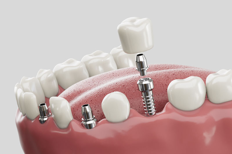 3 single dental implants with a crown on top of each of them