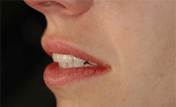 smile design