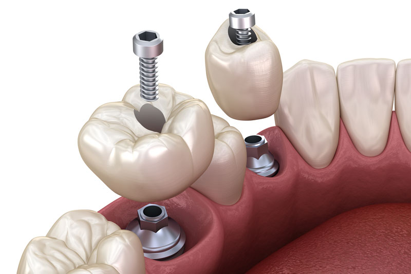 2 single dental implants being placed onto the jaw with crowns on top