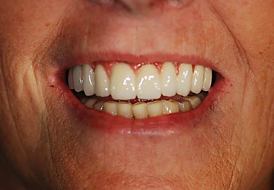 a full arch of teeth being placed onto the