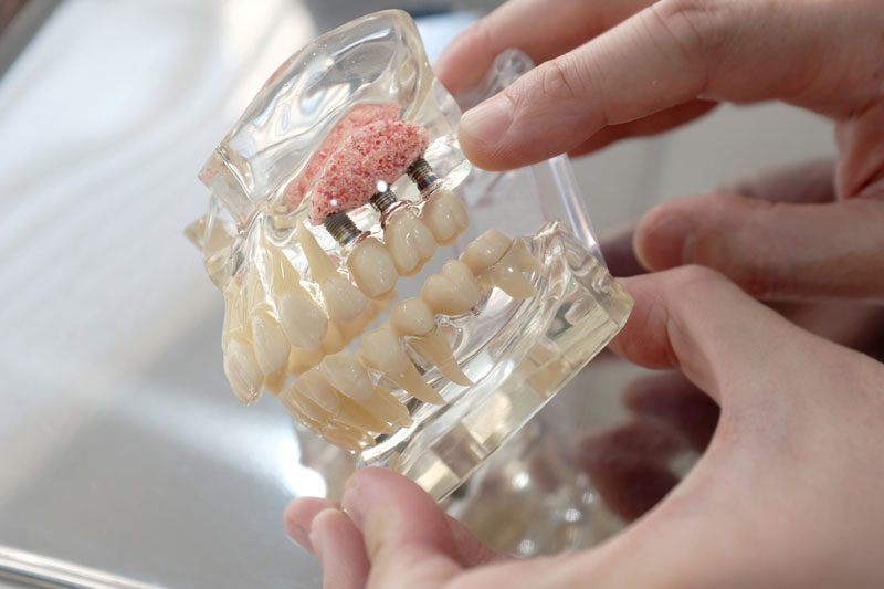 Dental Implants with a gum graft supporting the implant