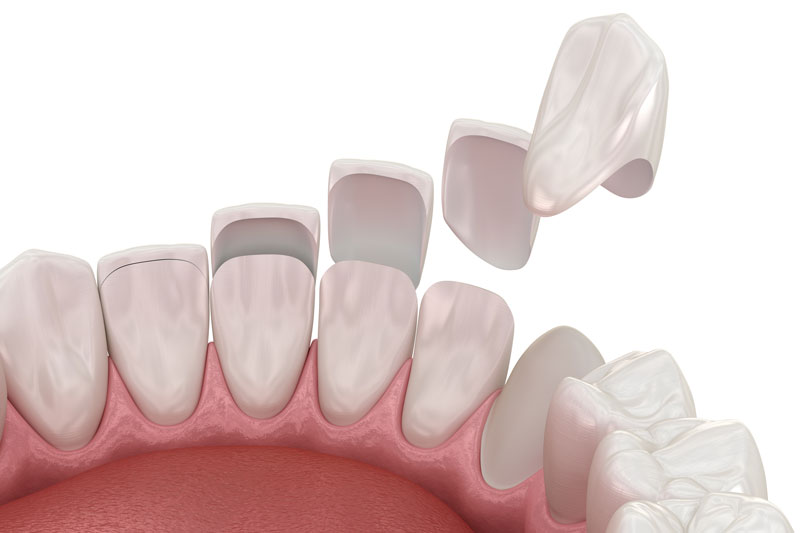 a set of veneers being placed onto the tooth