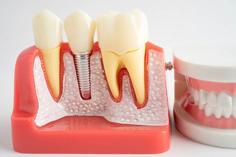 a dental implant with a model of a full arch sitting closely next to it